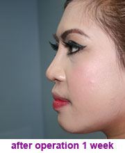 plastic_surgery_augmentation_rhinoplasty